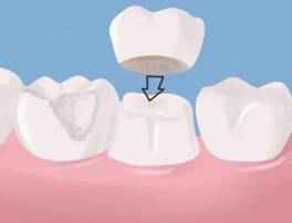 Crowns and Implants