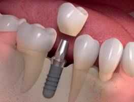 Dental Implants, Crowns and Veneers