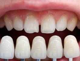 Dental Veneers