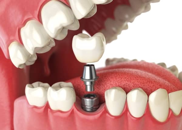Dental implants are artificial tooth roots that are surgically placed into the jawbone.
