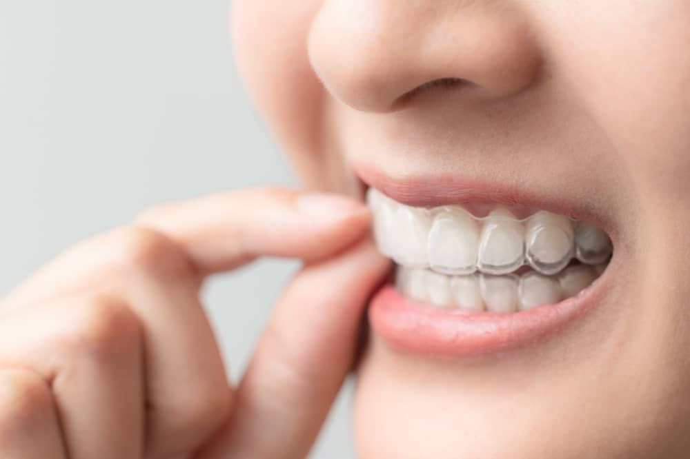 If you’re interested in an alternative to braces, clear aligners are a very popular solution and one worth looking into.