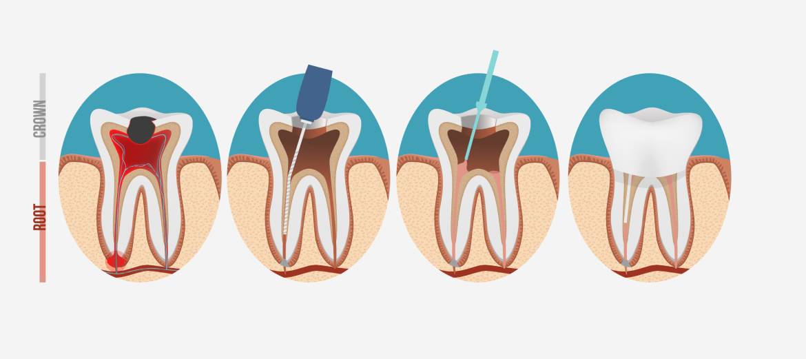 what is a root canal graphic