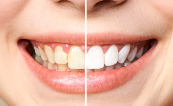 Boasting pearly white teeth can boost your confidence, make you look younger, and improve your smile