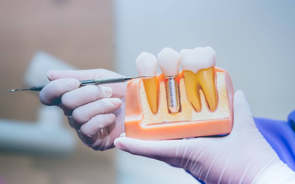 Dental implants are an artificial tooth root that is surgically placed into your jawbone to anchor the replacement tooth crown.