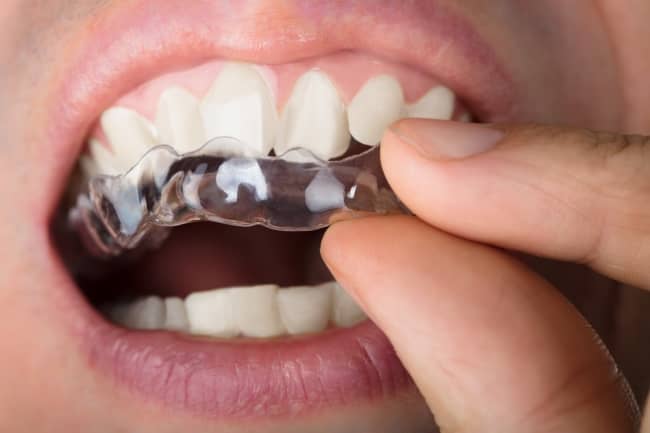 Cear aligners are great for treating overcrowded, crooked, and gapped teeth.