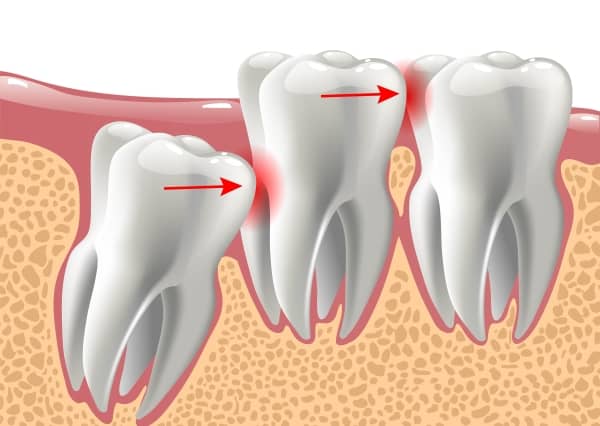 Wisdom teeth, also known as third molars, are the last set of teeth to develop in the human mouth. They typically emerge as young adults in their late teens or early twenties, although the timing can vary for each individual.