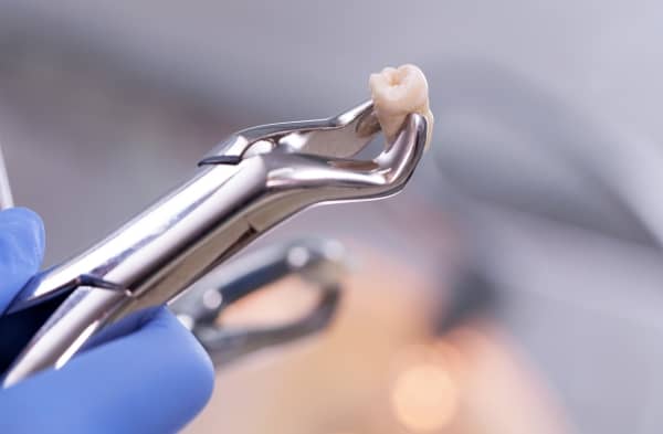 The procedure for wisdom teeth removal varies depending on the case’s complexity.