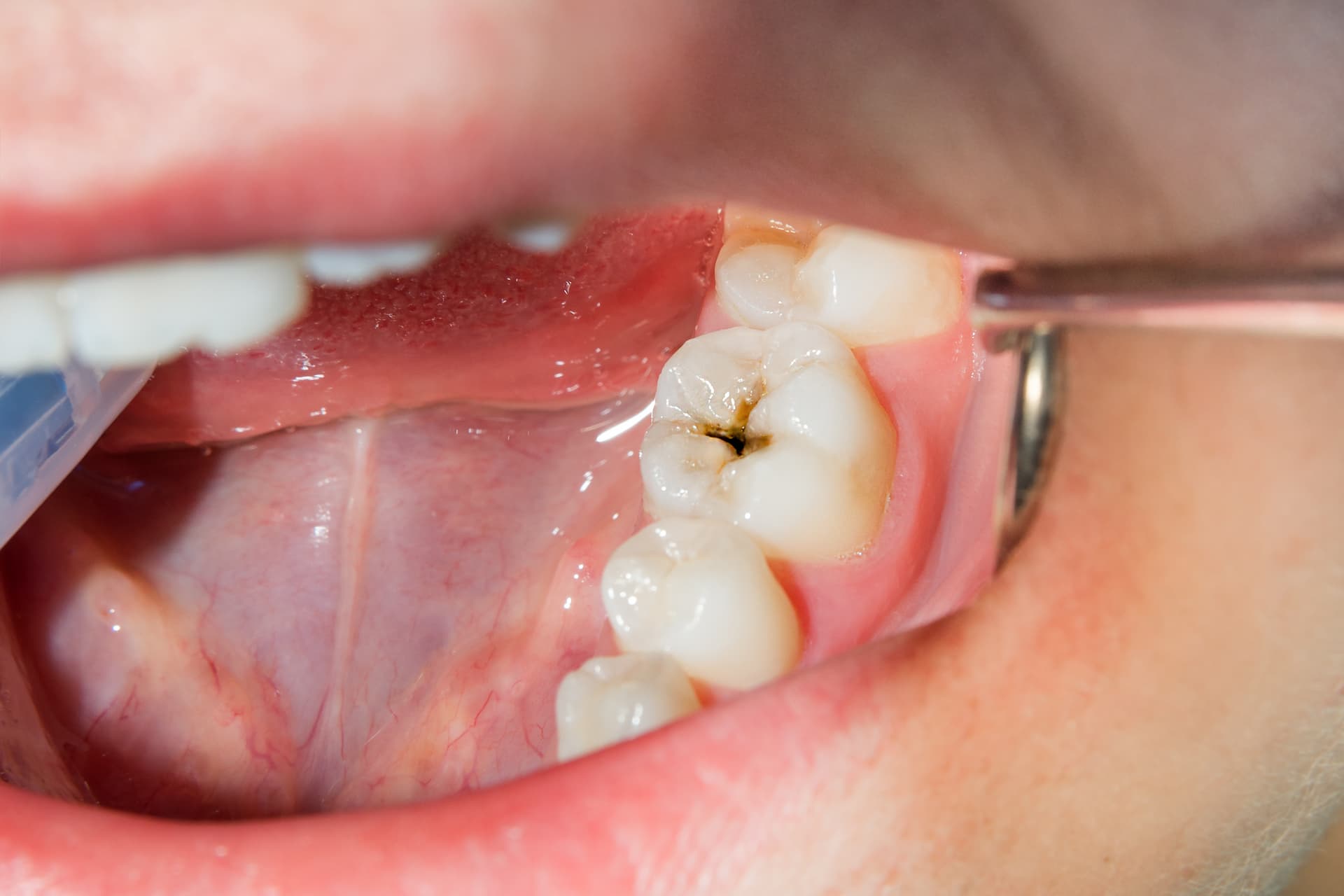 Close up view of cavities dentist Perth