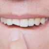 Close up off cracked teeth answering why are my teeth cracking all of a sudden?