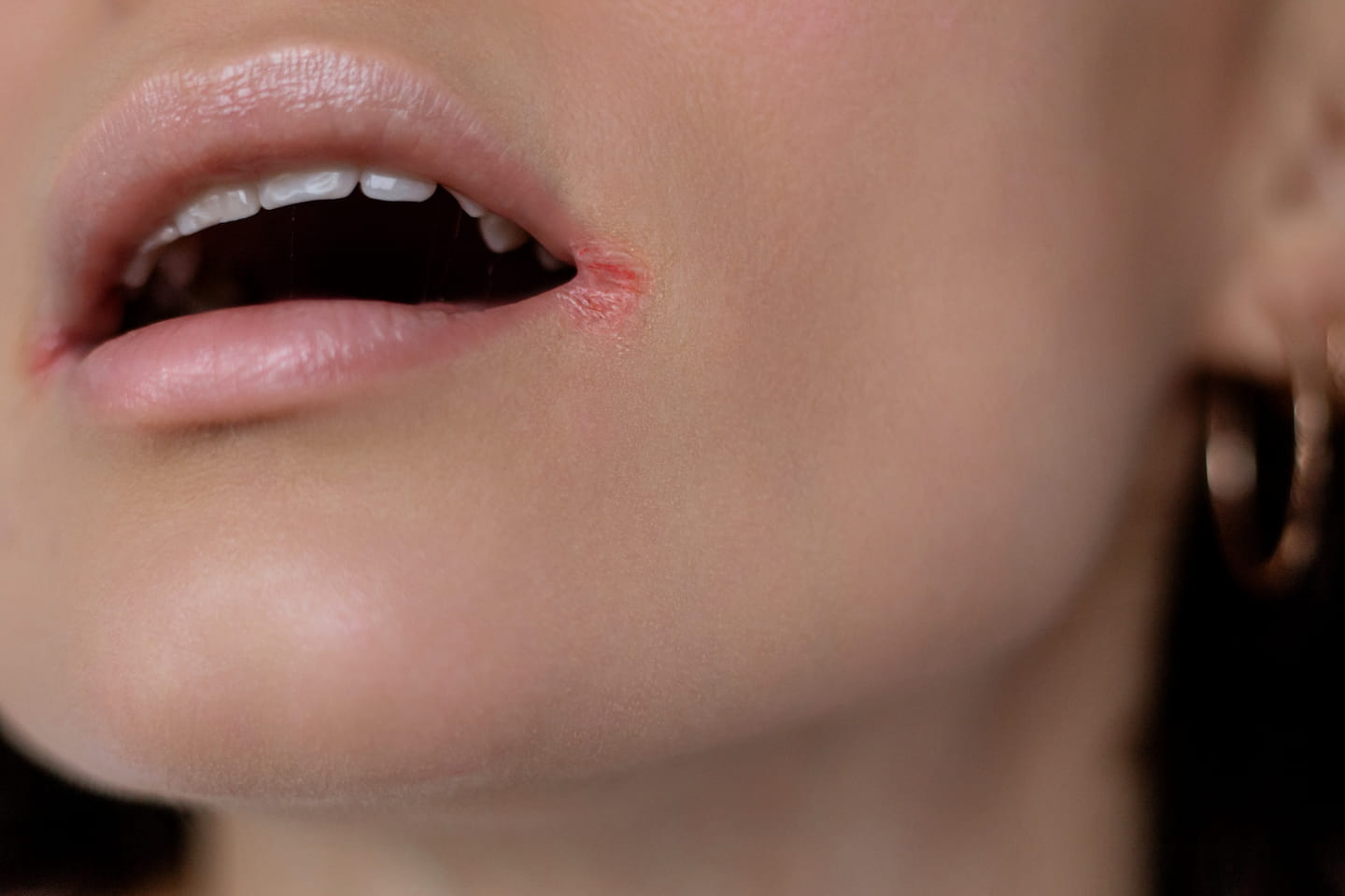 Dry mouth dentist in Perth