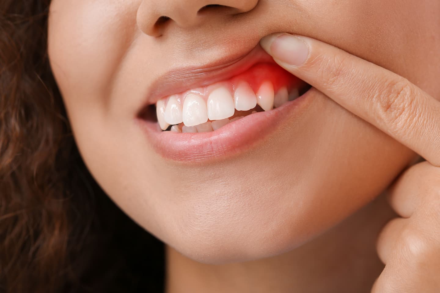Gingivitis dentist in Perth