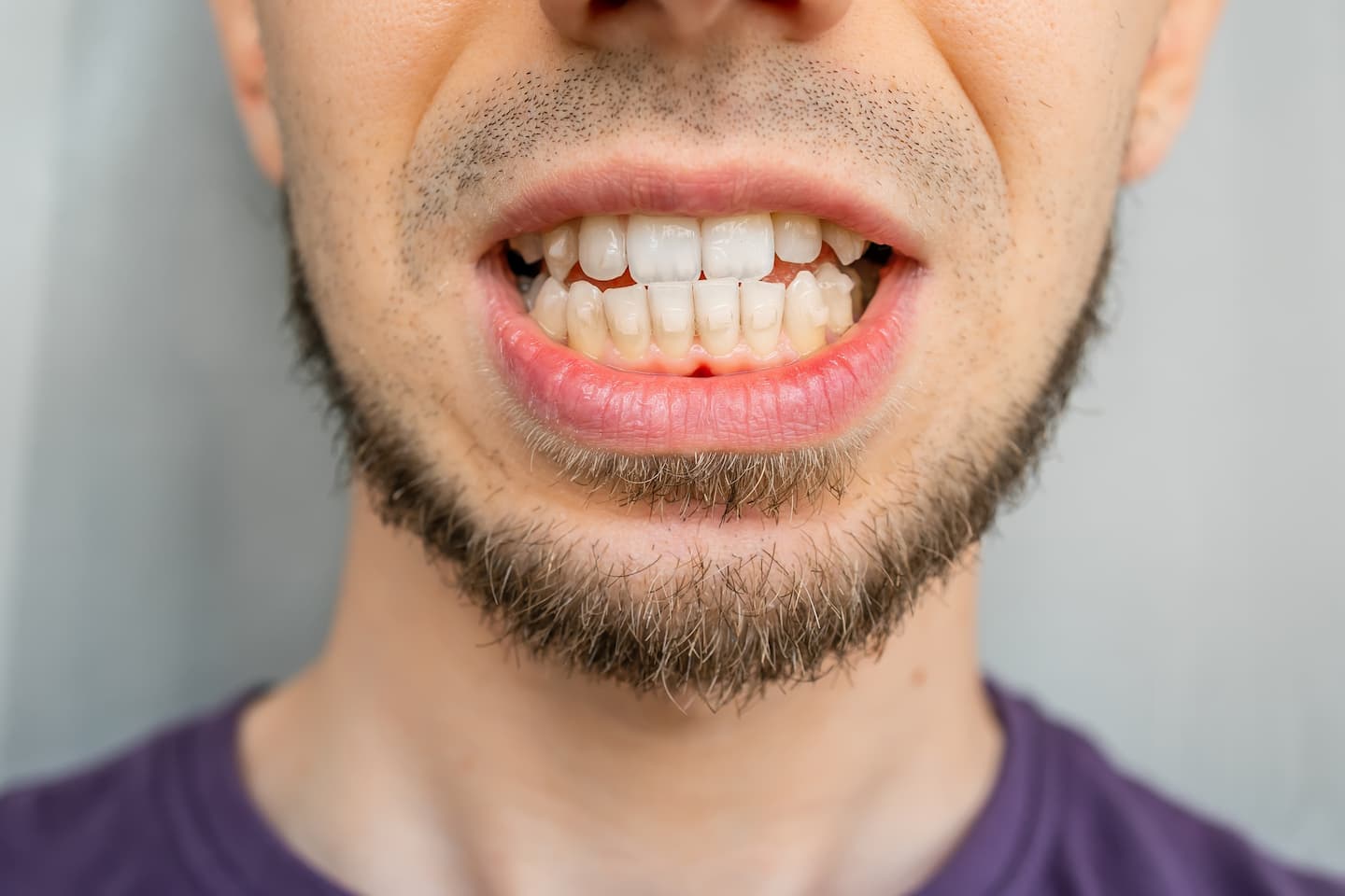 Malocclusion dentist in Perth