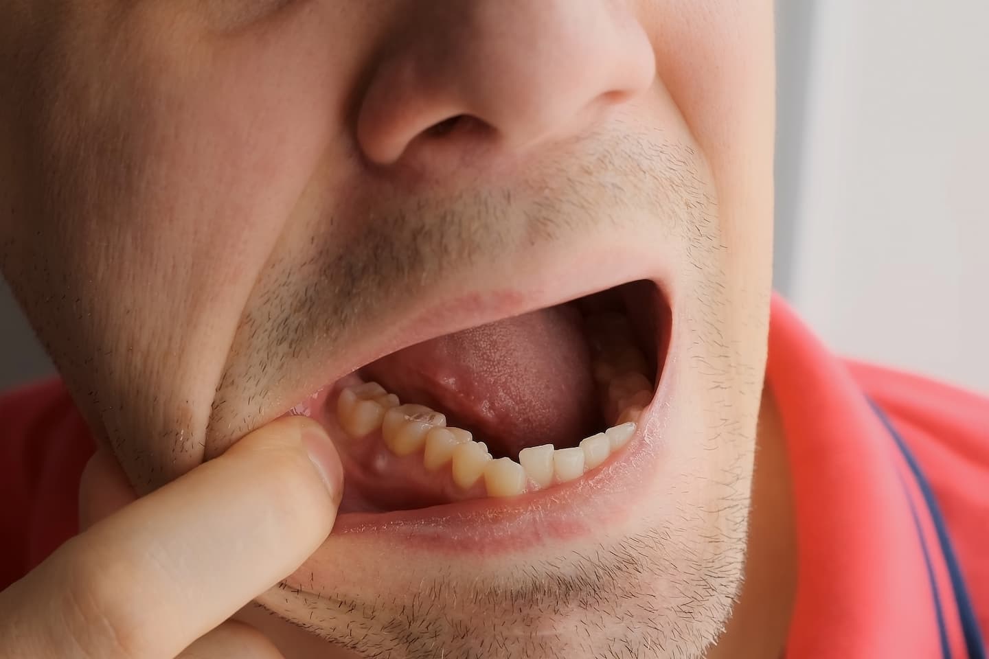 Tooth abscess dentist Perth
