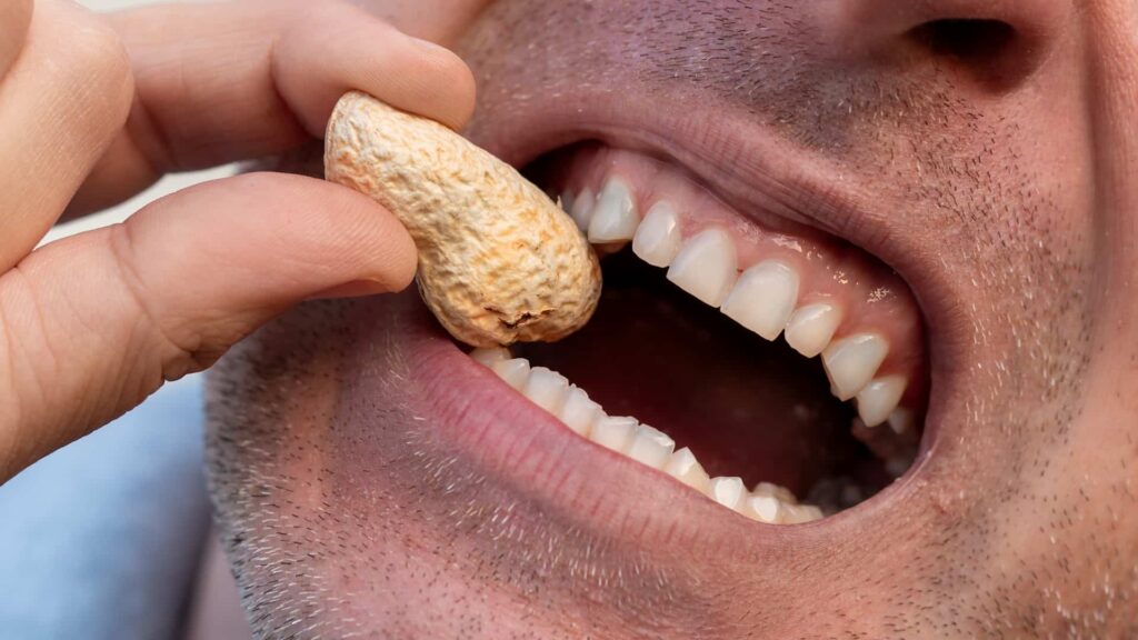 Man eating peanut causing cracked tooth
