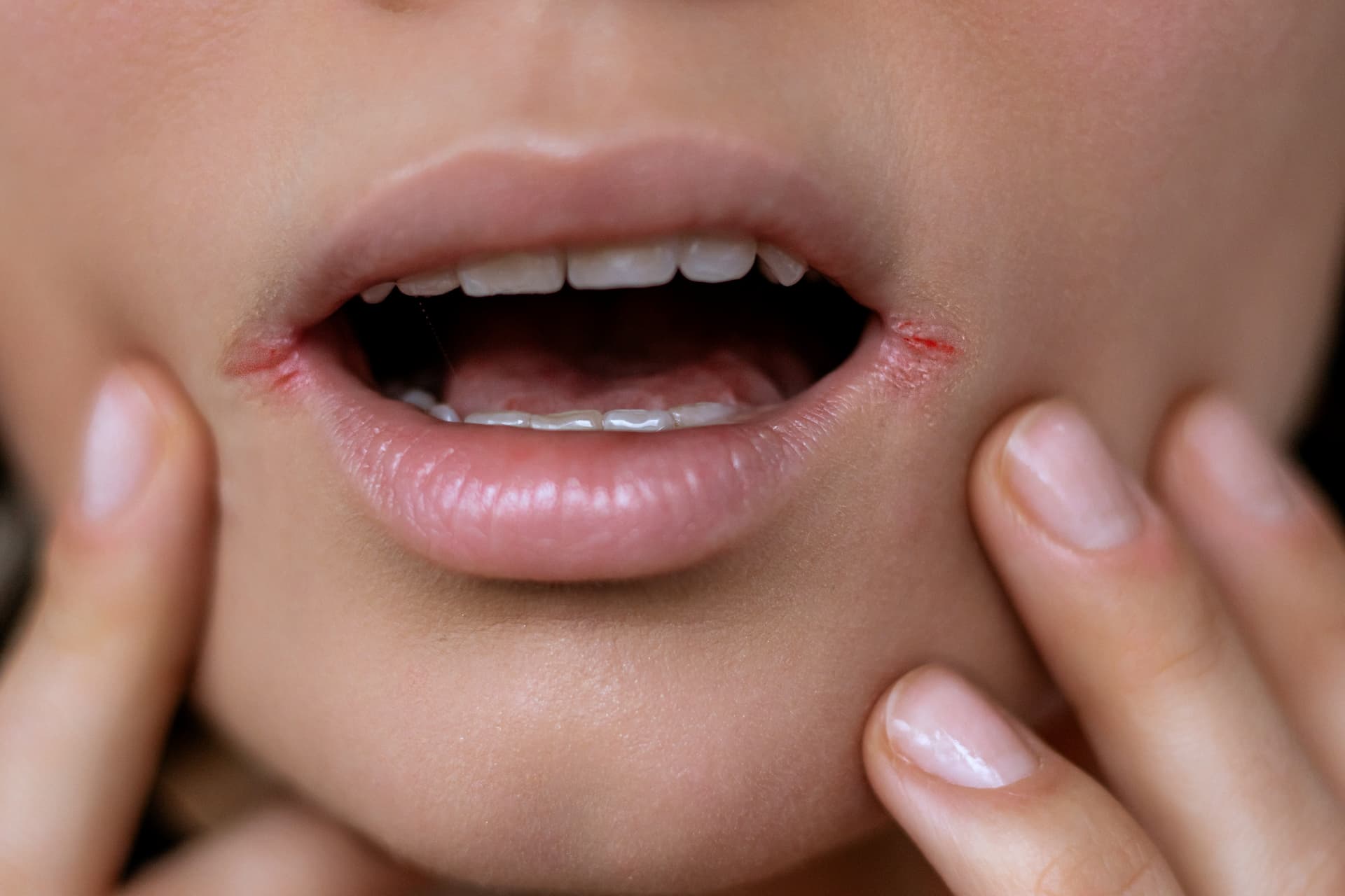 Person with dry mouth as one of the symptoms of halitosis