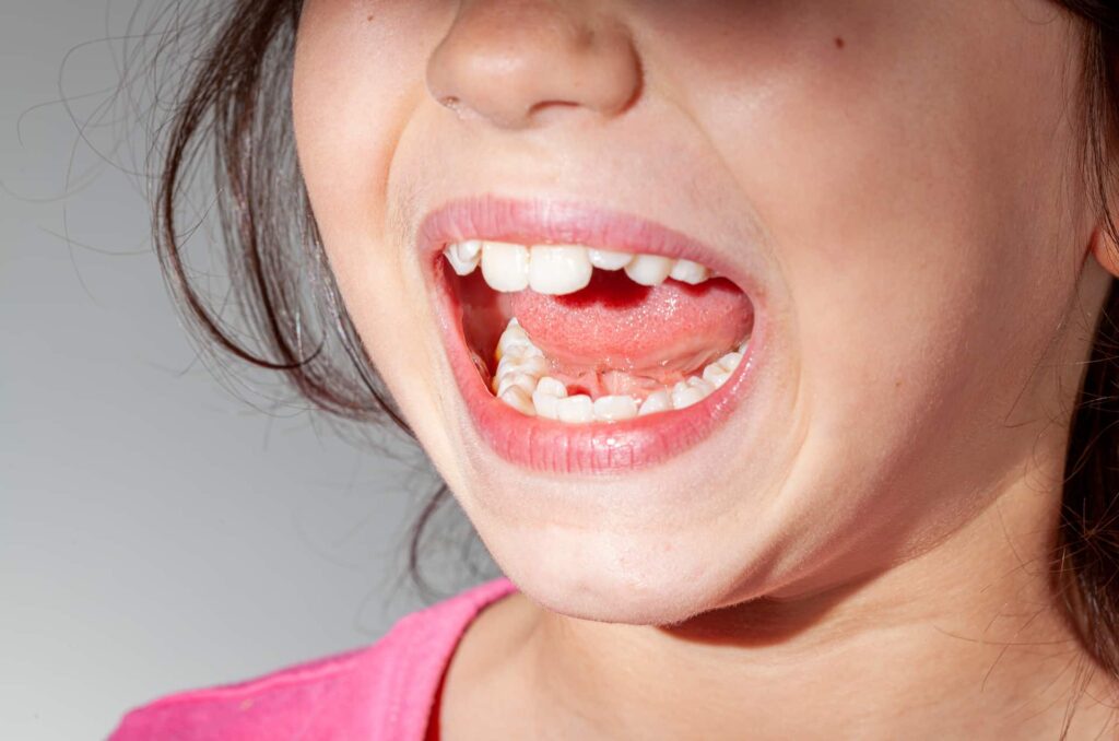 Young girl with overcrowded teeth in small jaw as an example of common causes of malocclusions